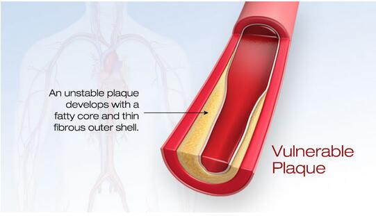 ؓ�x�ӵ����ÿ�����Ч�ί���Ѫ֬�Y